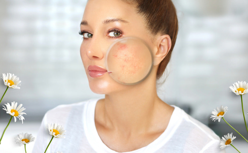 Acne e cambio di stagione