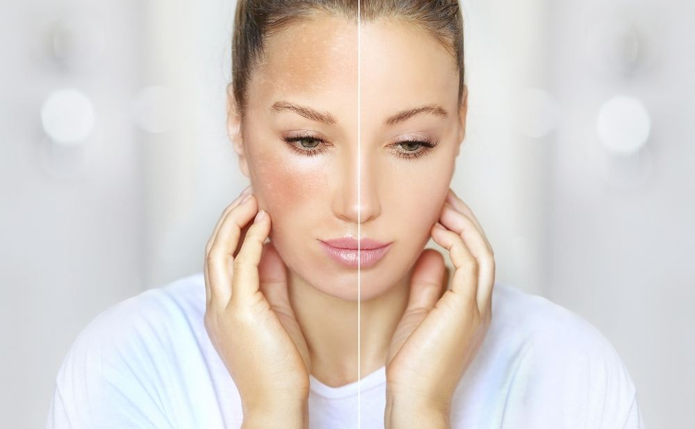 Come eliminare la macchie solari