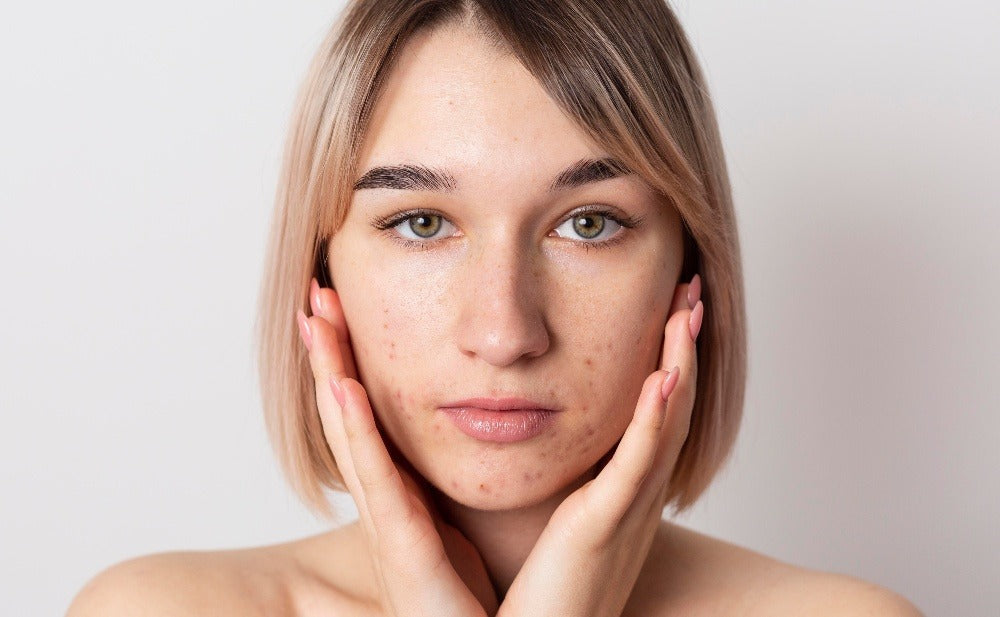 Maskne e inestetismi cutanei da mascherina. 7 prodotti rivoluzionari e rimedi utili.