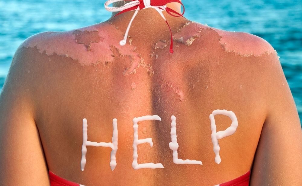 rimedi per spellature da sole